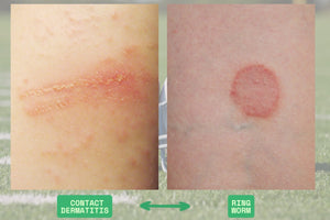 Contact Dermatitis vs Ringworm: What to Know