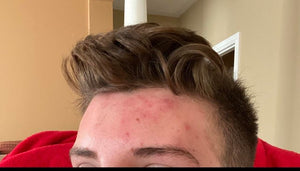 HOW DO YOU GET RID OF HELMET ACNE?