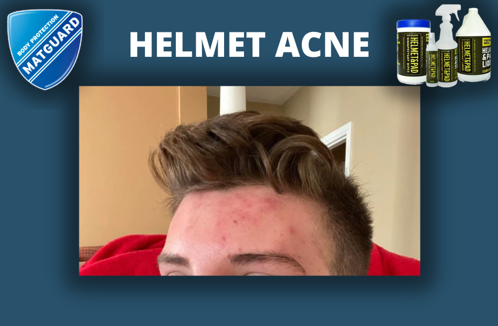 Prevent Helmet Acne with Helmet & Pad Wipes