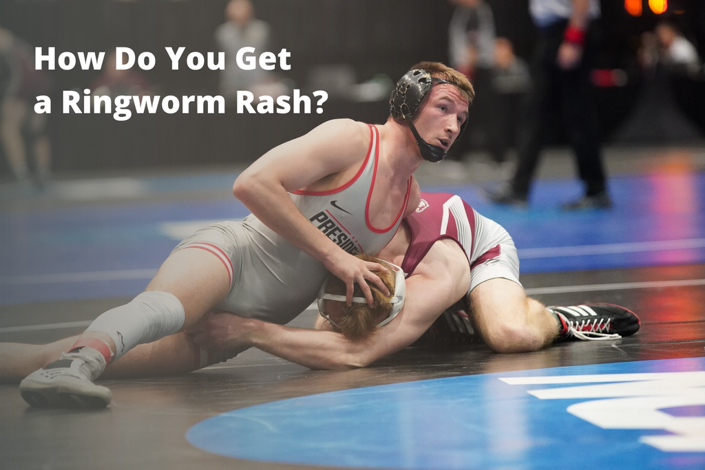 How Do You Get a Ringworm Rash