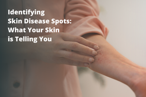 Identifying Skin Disease Spots: What Your Skin is Telling You