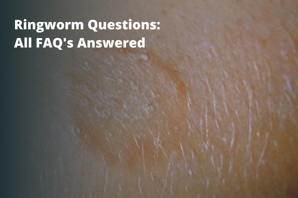 Ringworm Questions: All FAQ's Answered