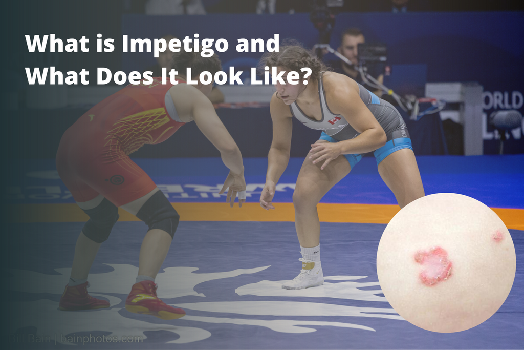 What is Impetigo and What Does It Look Like?