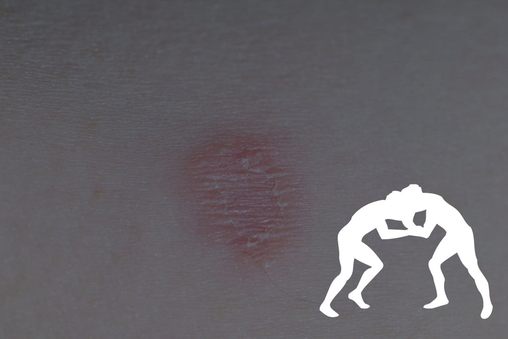How Does Ringworm Spread