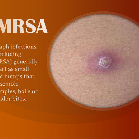 Questions and Answers About MRSA for Athletes