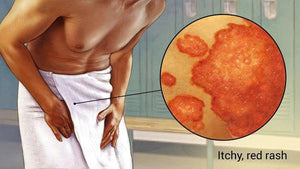 RINGWORM ADVICE FOR ATHLETES AND PARENTS