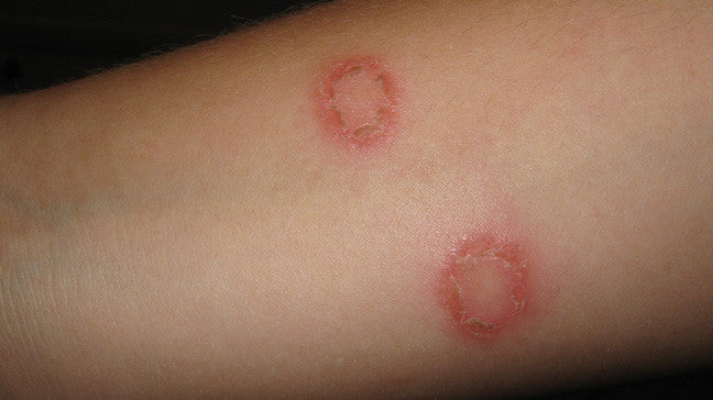 Skin Diseases You Can Get at the Gym, Including Ringworm and Warts