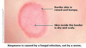 Ringworm Prevention