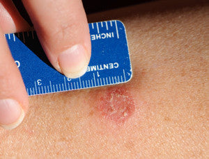 Common Wrestling Skin Diseases